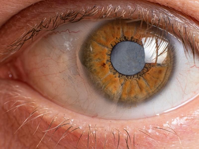 Guia Definitivo Sobre Capsulotomia com YAG Laser: Tudo o que Você Precisa Saber sobre Capsulotomia com YAG Laser
