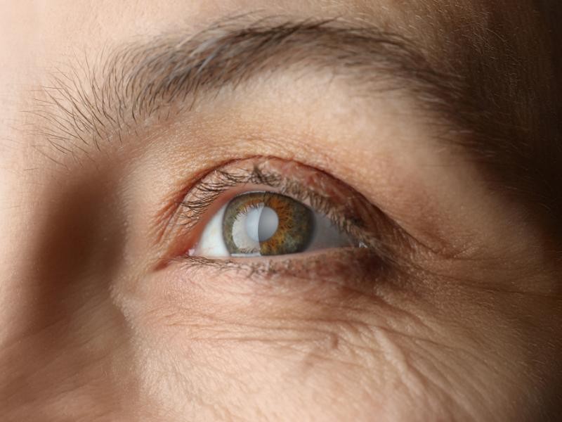 Guia definitivo da Cirurgia de Catarata: Tudo o Que você Precisa Saber Sobre Cirurgia de Catarata