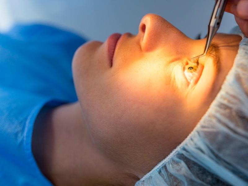 Guia Definitivo da Cirurgia Refrativa: Tudo o que Você precisa Saber Sobre Cirurgia Refrativa